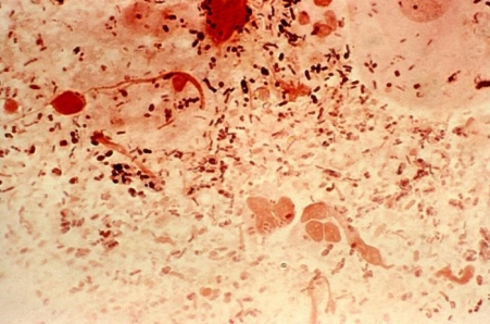 Gonorrhea Gonorrhea